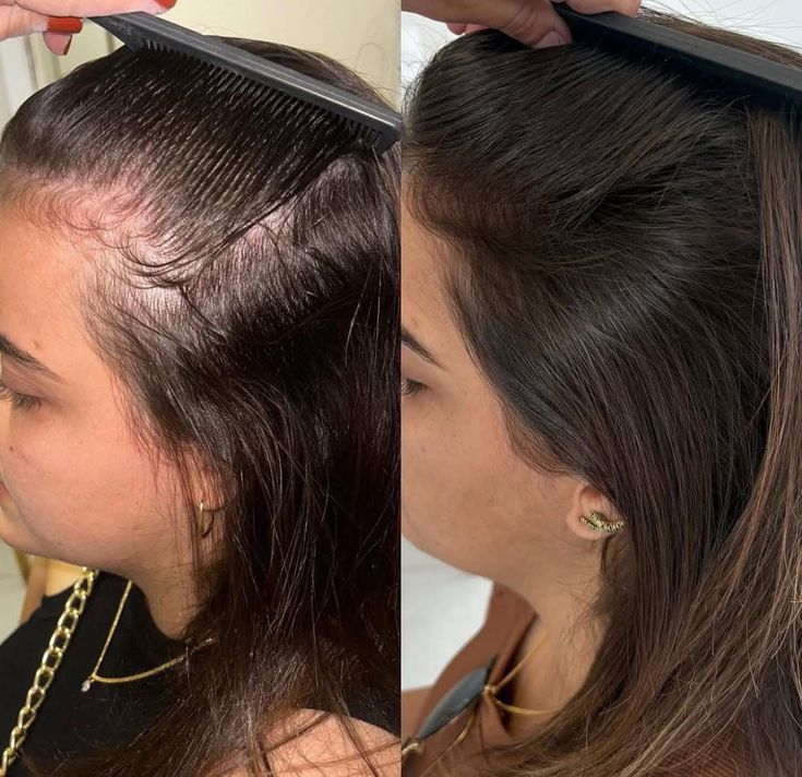 Thicker, Fuller Hair in as Little as 90 Days
